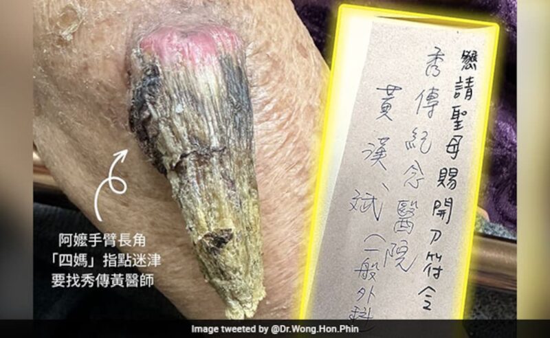 Ultra-Rare "Fairy" Horn Grows On Woman's Arm In Taiwan